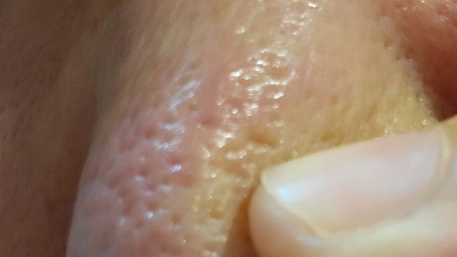 鼻の毛穴から脂が出て臭い
